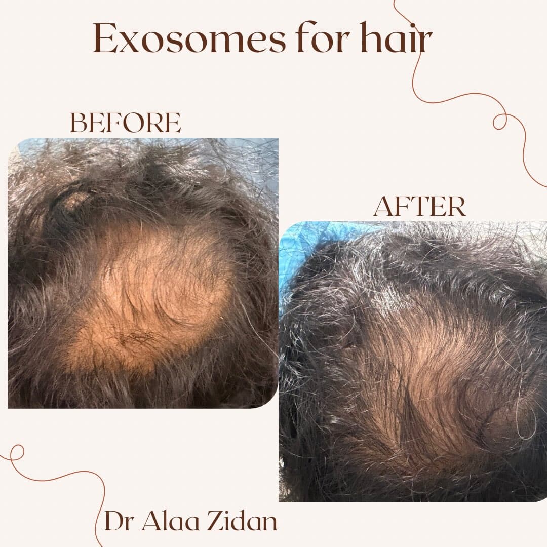Exosomes for Hair