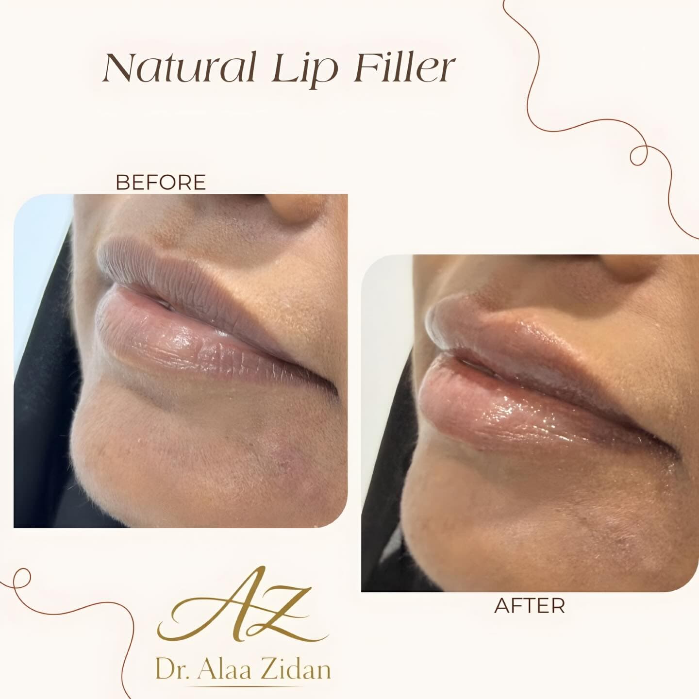 Lip & Facial Filler